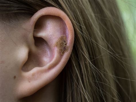 Why is my old ear piercing scabbing?